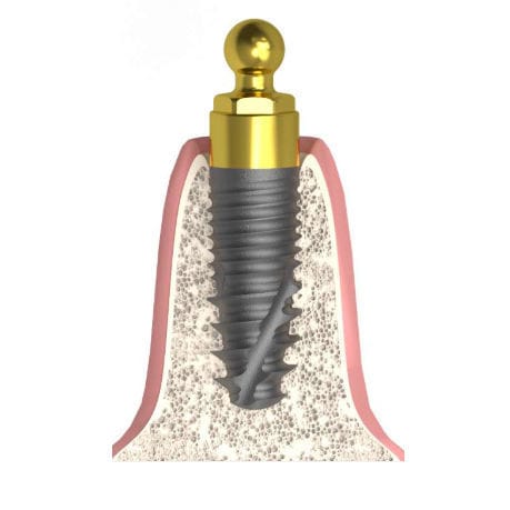 Cylindrical implant abutment - Actival - Bionika Medline Kft. - ball / straight / for dental clinics