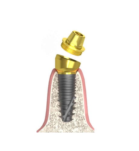 Conical implant abutment - Actival - Bionika Medline Kft. - tapered / internal / angled