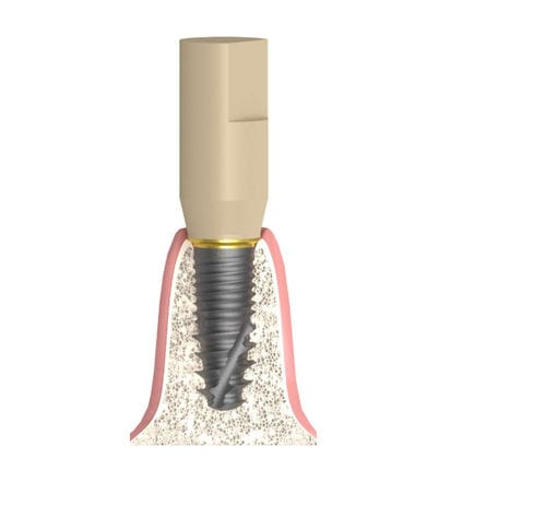 Intraoral scanbody - Bioplant - Bionika Medline Kft.
