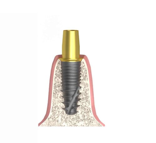 Cylindrical implant abutment - Bioplant - Bionika Medline Kft. - titanium / hexagonal / internal