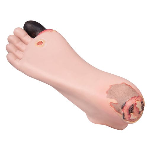 Decubitus ulcer treatment simulator - P14 - 3B Scientific   - for diabetes / foot