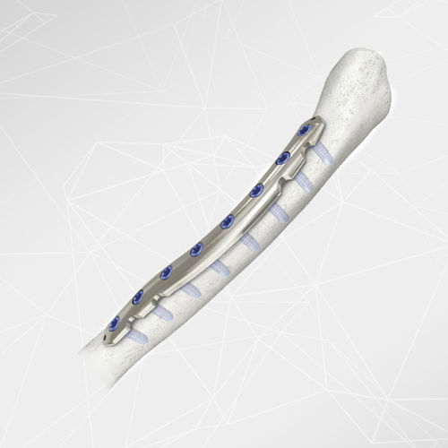 Clavicle compression plate - LOQTEQ® 2.7 - aap Implantate - lateral / mid-shaft / locking