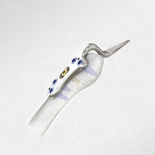 Acromioclavicular joint compression plate - LOQTEQ® 2.7 - aap Implantate - locking / metallic