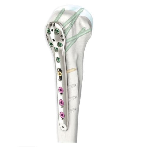 Humerus compression plate - LOQTEQ® 3.5 - aap Implantate - proximal / locking / metallic
