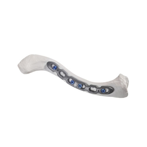 Clavicle compression plate - 10-54766 - AF Medical   - anterolateral / locking / metallic