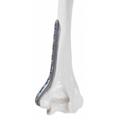 Humerus compression plate - 10-54103 - AF Medical   - distal / medial / locking