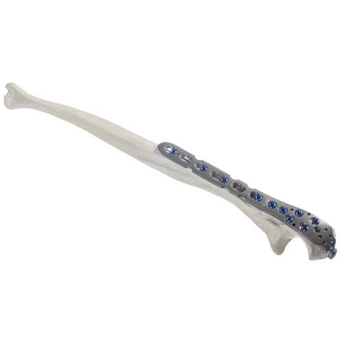 Olecranon compression plate - 10-54322 - AF Medical   - locking / metallic
