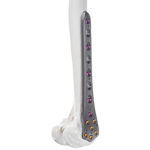Femur compression plate - 10-63105 - AF Medical   - distal / locking / metallic