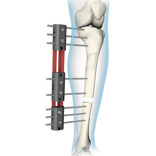 Tibia external fixation system - 563.30 - BAUMER - femur / tubular / adult