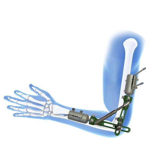 Elbow external fixation system - 566 - BAUMER  - tubular / adult