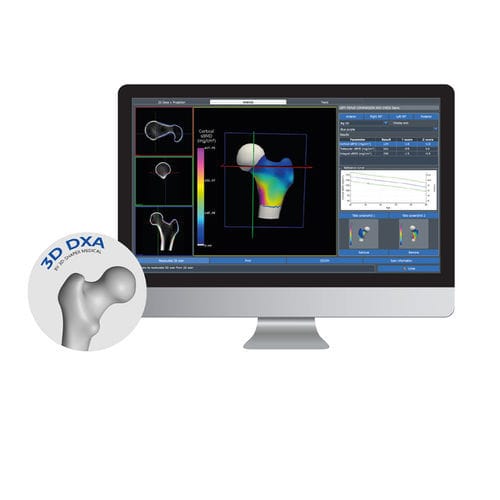 3D viewing software - 3D-DXA - DMS Imaging - for bone densitometry
