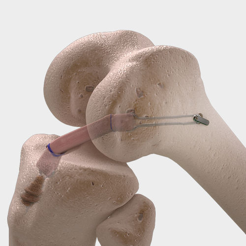 Anterior cruciate ligament ligament prosthesis - CorTTape® - FH Orthopedics - posterior cruciate ligament / synthetic