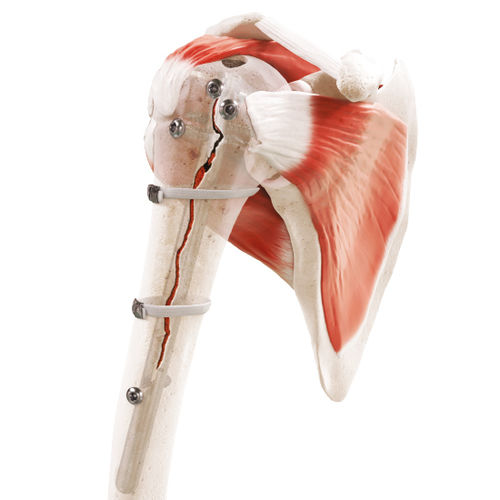 Periprosthetic fracture bone cerclage wiring - Strapflex - FH Orthopedics - multifilament polymer