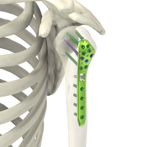 Humerus compression plate - Jeil Medical Corporation - proximal / locking / titanium