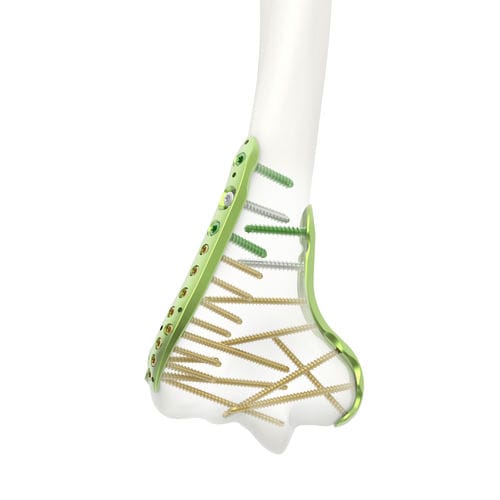 Humerus compression plate - Jeil Medical Corporation - distal / locking / titanium