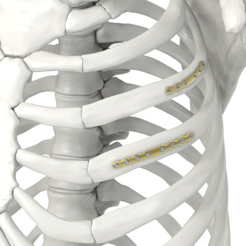 Rib compression plate ARIX Rib 2.4 Jeil Medical Corporation