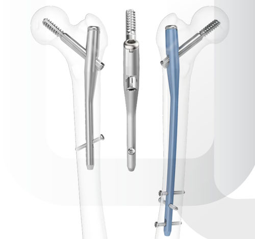 Femoral intramedullary nail - ARIX - Jeil Medical Corporation - proximal fixation / mid-shaft fixation / right