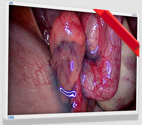 Medical monitor - EndoVue Plus - NDS Surgical Imaging - endoscopy / high-definition / 55"