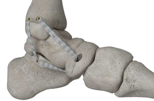 Posterior tibial tendon ligament prosthesis - Infinity-Lock&reg; - Neoligaments - synthetic