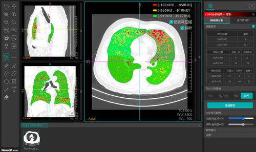 Visualization software - NeuLungCARE - Neusoft Medical Systems  - analysis / CAD / measurement