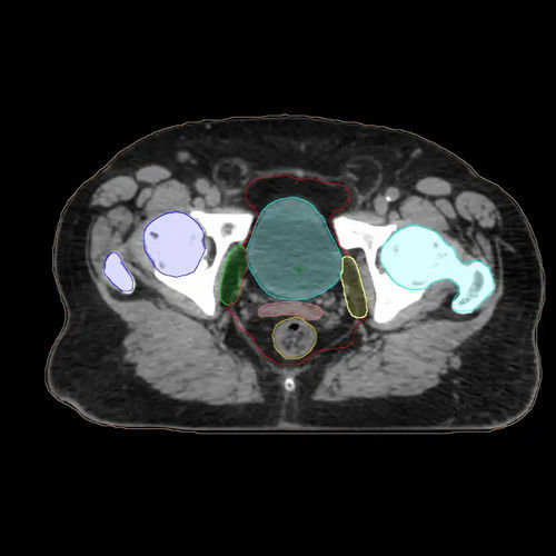 Medical AI platform - Varian Oncology - contouring / treatment planning