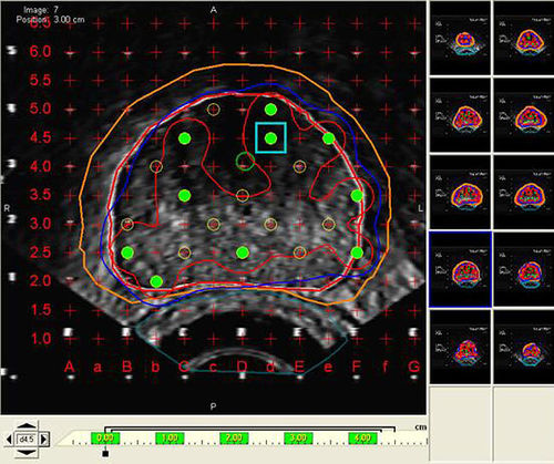 Visualization software - VariSeed™  - Varian Oncology - treatment planning / import / medical