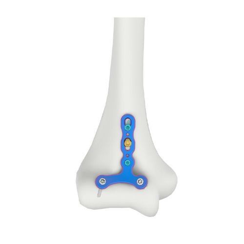 Humerus osteotomy plate - VAL Humeral Capitellum Trochlea - Double Medical Technology - locking