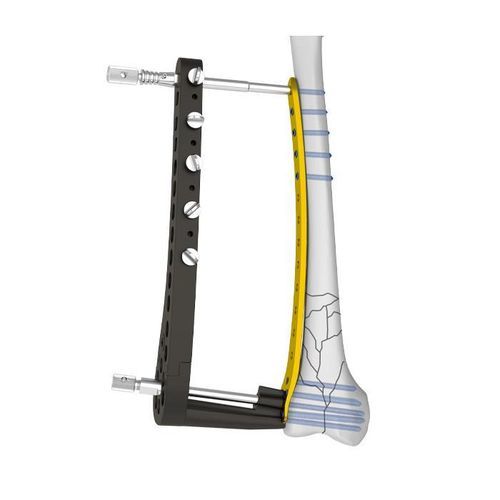Femoral osteotomy plate - Double Medical Technology - distal / locking