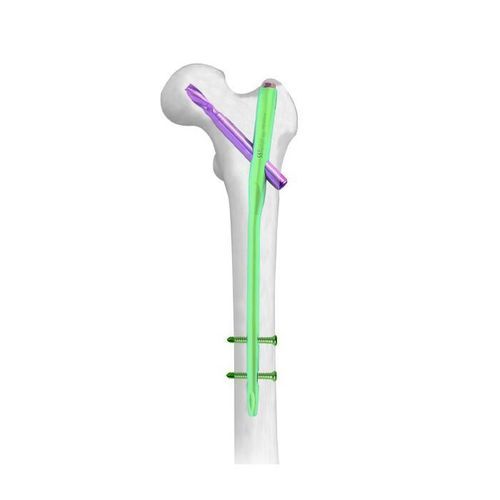 Trochanter intramedullary nail - PFNA - Double Medical Technology - femur / proximal fixation / distal fixation
