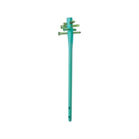 Humeral intramedullary nail - TRIGEN™ - Smith & Nephew - proximal fixation / distal fixation / metallic