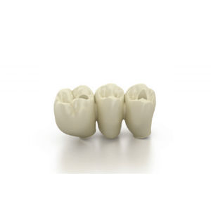 Anatomical dental bridge - ANTHOGYR  