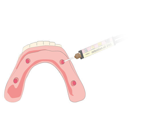 Implant system dental adhesive - retention.sil  - bredent medical - for dental prostheses