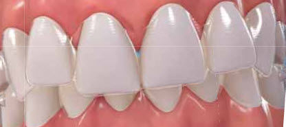 Dental aligner - Invisalign - Align Technology