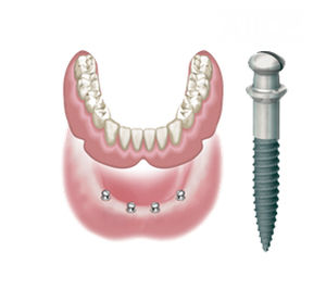 Tapered dental implant - ATLAS  - DENTATUS AB   - titanium / external / one-stage
