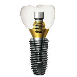 Tapered dental implant - SuperLine - Dentium - titanium / internal hexagon