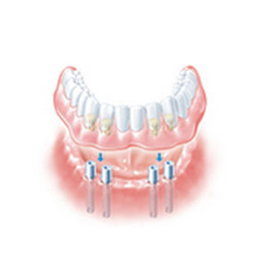Straight implant abutment - ANKYLOS® SynCone® - DENTSPLY Implants GmbH