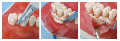 NISSIN 顎模型 SRP実習用 D16FE-500HPRO-S1A1-GSE Nissin Study Model Archives - New Citizens Dental Supply and