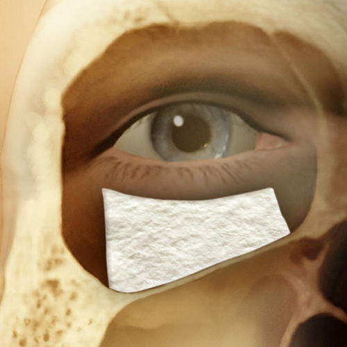 Xenograft bone substitute LS35LS Tecnoss Dental for maxillofacial