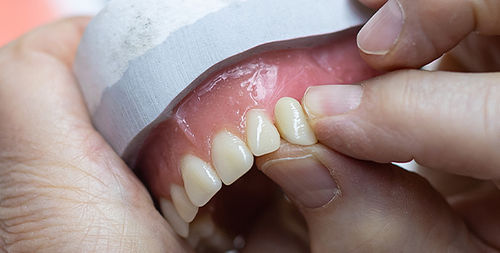 Composite dental prosthesis - VITAPAN®  - VITA Zahnfabrik H. Rauter GmbH & Co.KG   - anterior teeth