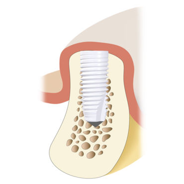 Cylindrical dental implant - Z5-BL - Z-Systems AG   - ceramic / internal / straight