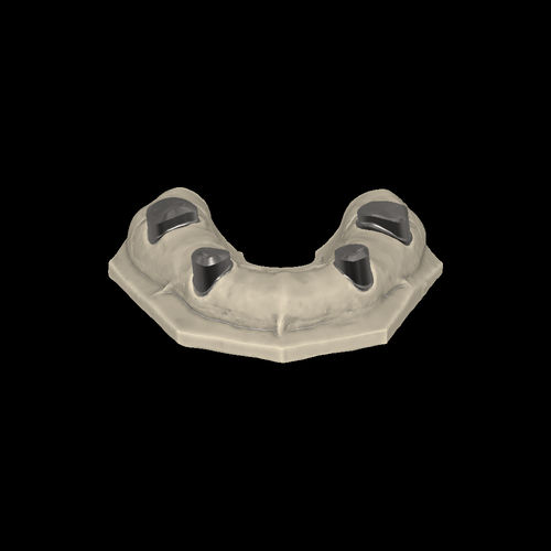 CAD software module - Telescopic crowns - Zirkonzahn - for dental prosthesis design / CAM / for dental laboratories