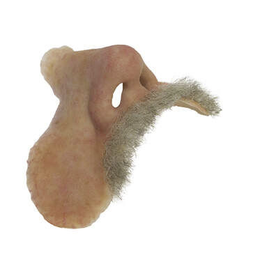 Nasal cosmetic prosthesis - The Anaplastology Clinic - adult