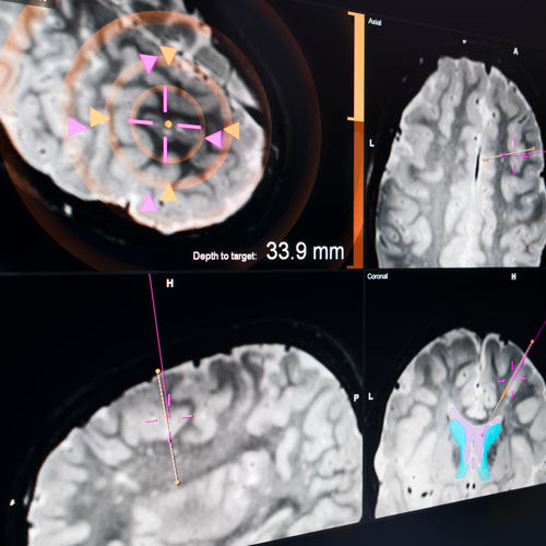 Control software - EM - Brainlab - calibration / surgical navigation / hospital