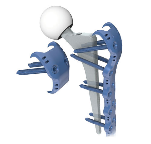 Femoral periprosthetic plate - 3.72 series - ChM - proximal / locking / titanium