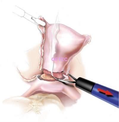 Laparoscopic electrode - LapLoop  - OPTEC Endoscopy Systems - wire loop / monopolar