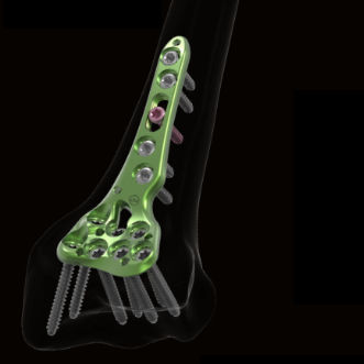 Radius compression plate - DETGVN1 - Newclip Technics - distal / locking / metallic
