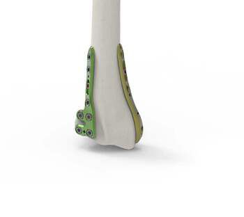 Ulna compression plate - DTGQ2 - Newclip Technics - distal / anterolateral / locking