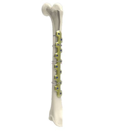 Femur osteotomy plate - PERIACTIV - Newclip Technics - locking / metallic