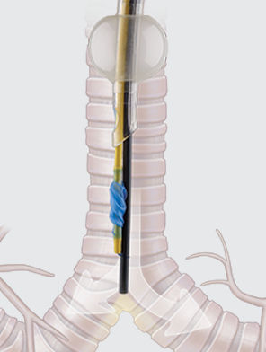 Double-lumen endobronchial blocker - COOK Medical - single-lumen