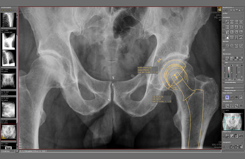 Planning software module - dicomPACS® Prosthesis  - OR Technology - Oehm und Rehbein - medical imaging / orthopedic surgery